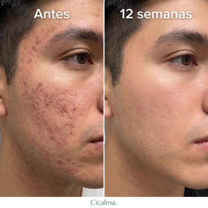 Scar Stick Cicalma — Barra Reparadora de Cicatrices